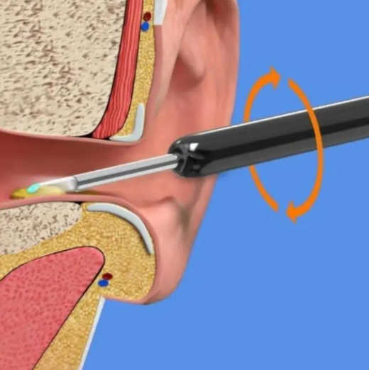 Earsmart ProClean: Smart Earwax Remover